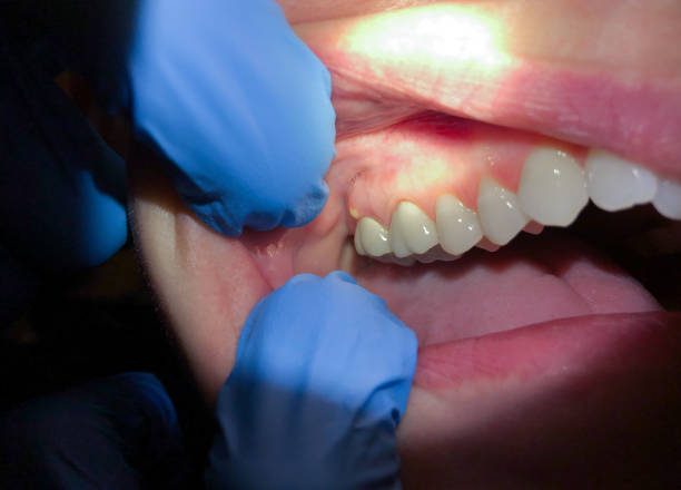 Best Emergency Dental Care for Broken or Chipped Teeth in Elbow Lake, MN